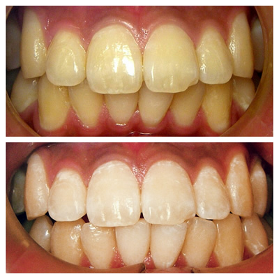 ホワイトニング例2