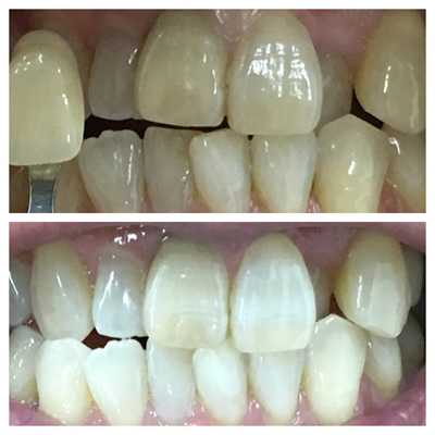 ホワイトニング例4