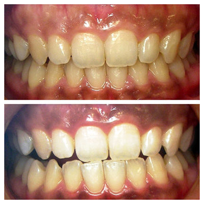 ホワイトニング例3