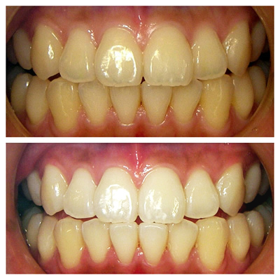 ホワイトニング例1